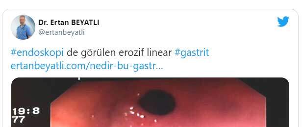 #endoskopi de görülen erozif linear #gastrit http://ertanbeyatli.com/nedir-bu-gastrit