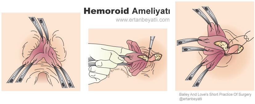 Hemoroid ameliyatının aşamaları (Bailey And Love's Short Practice Of Surgery @ertanbeyatli)