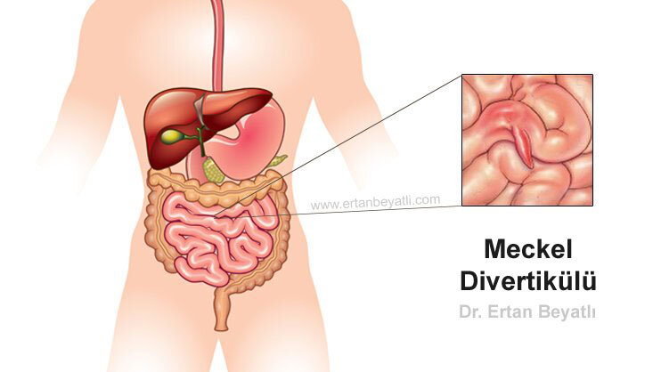 Meckel Divertikülü nedir?