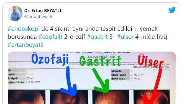 aynı hastada özofajit, gastrit, ülser ve mide fıtığı