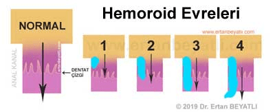 Hemoroid (basur) derece ve evreleri
